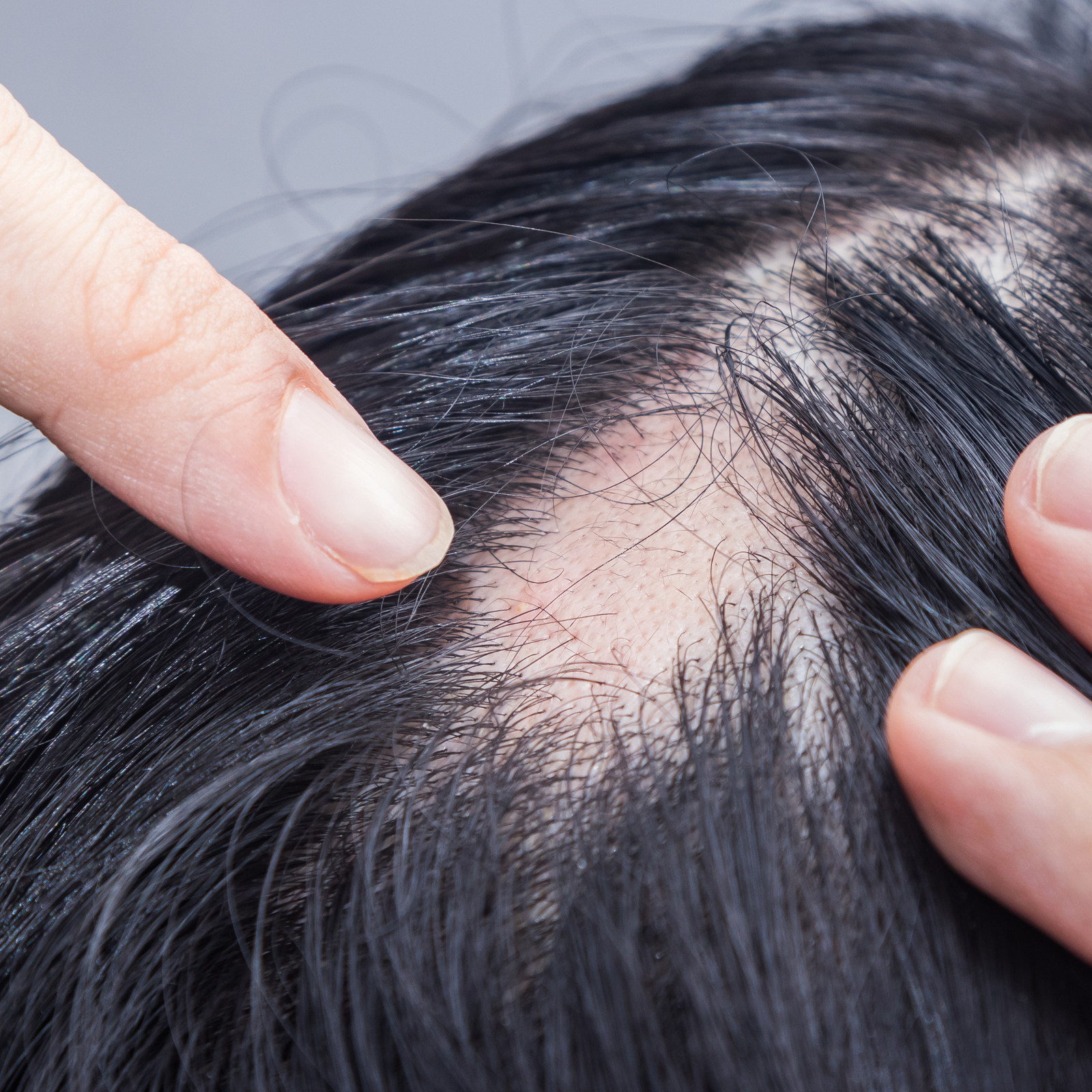 Alopecia