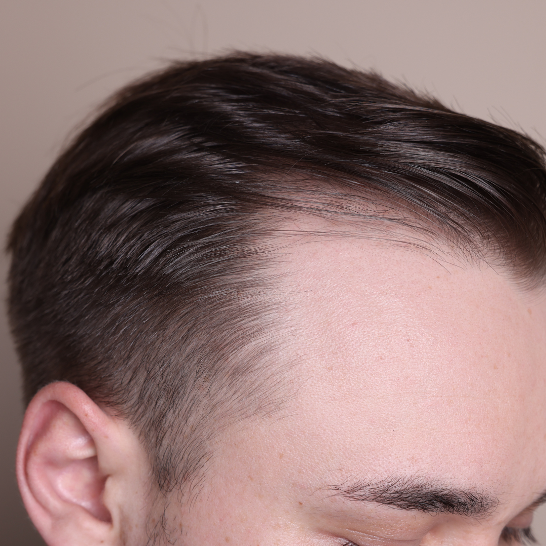 Receding Hairline
