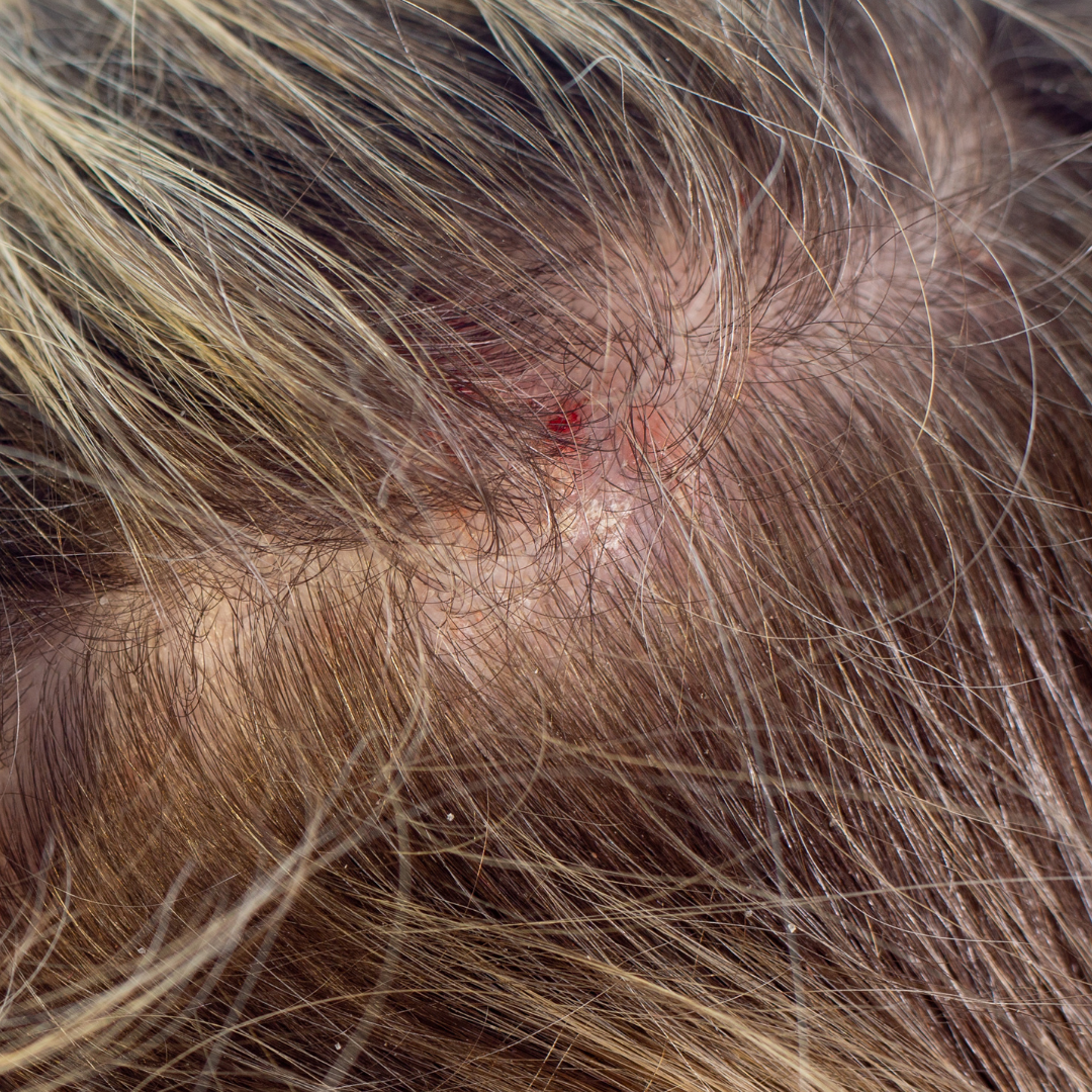 Scalp Inflammation