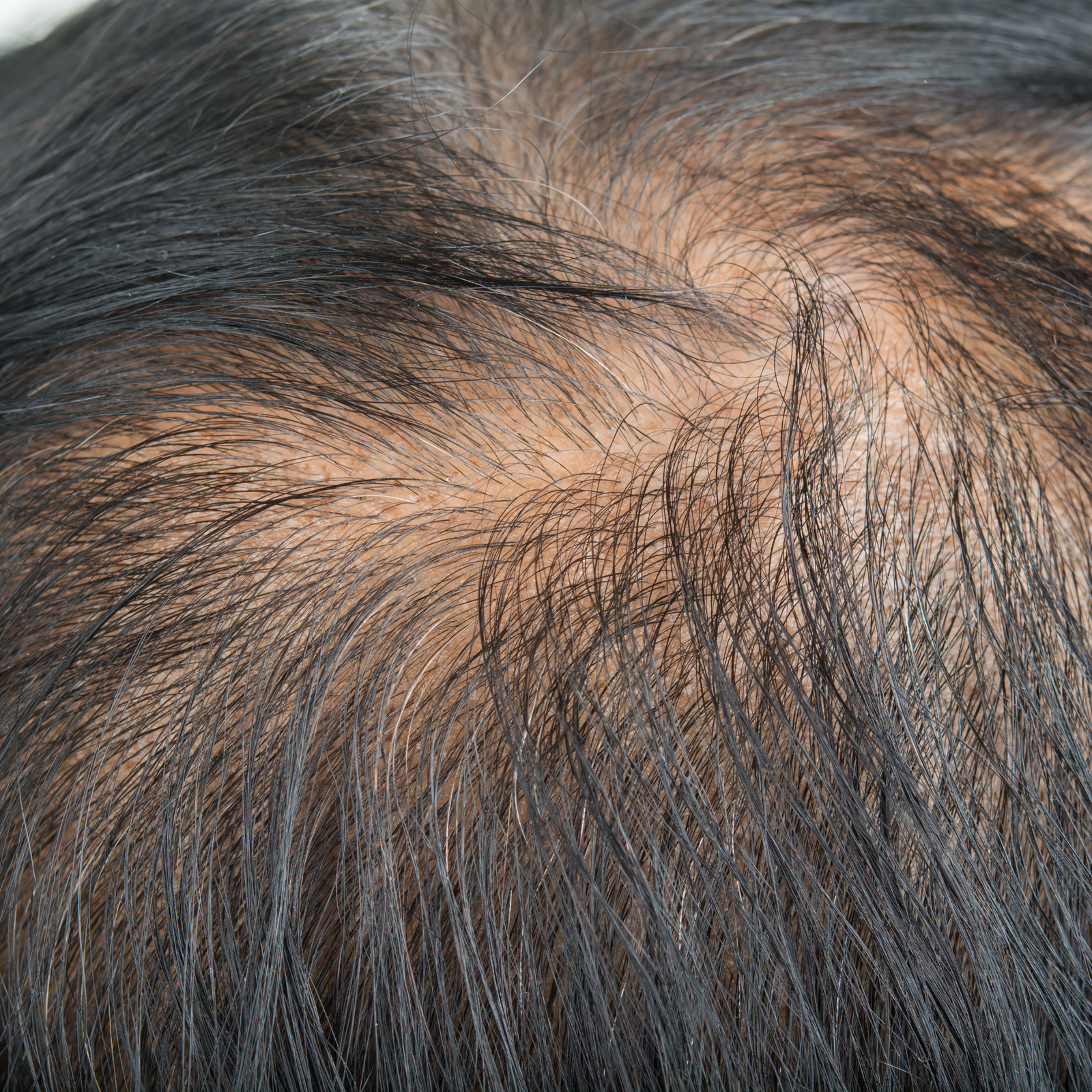 Thinning Hair